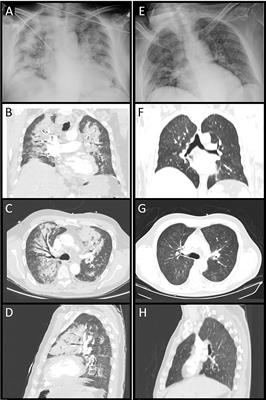 Catecholaminergic Crisis After a Bleeding Complication of COVID-19 Infection: A Case Report